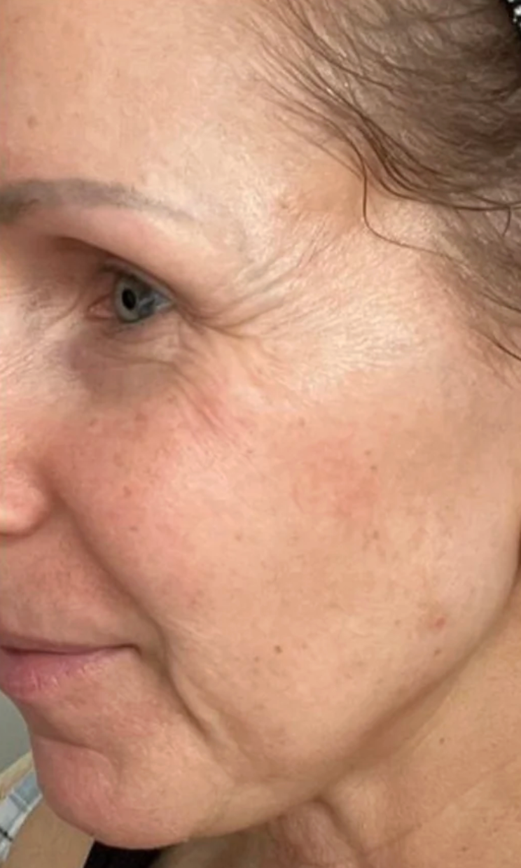Before - Week 0